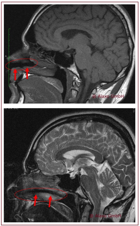 MRI felvétel az AlaxoLito-ról